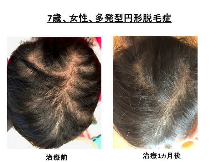 円形脱毛症　病院